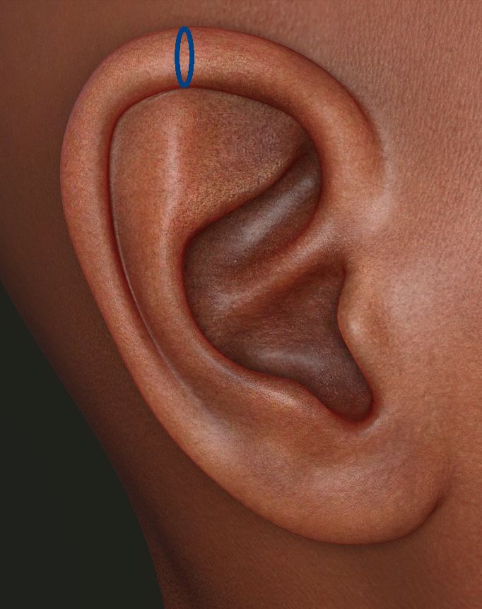 allergia piercing elhelyezkedése